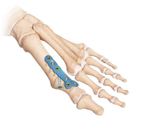 Arthrex - MTP Joint Arthrodesis