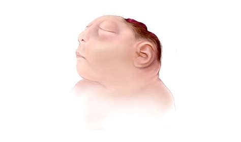 Anencephaly: Causes, Symptoms, Prevention - StoryMD