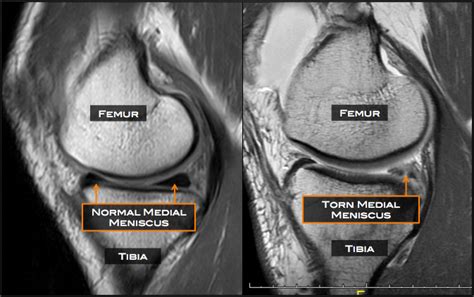 Torn Medial Meniscus Tear