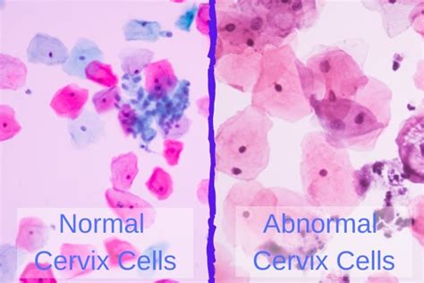 Atypical Squamous Cells Cervix