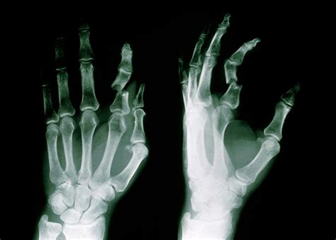 X-ray Of Fractured Forefinger (phalanx) Of Hand Photograph by Medical ...