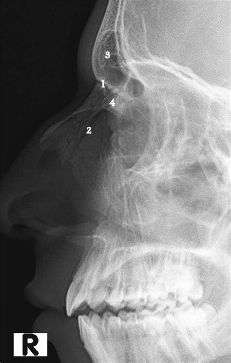 Nasal bones - x-ray | Radiology Case | Radiopaedia.org Radiology ...