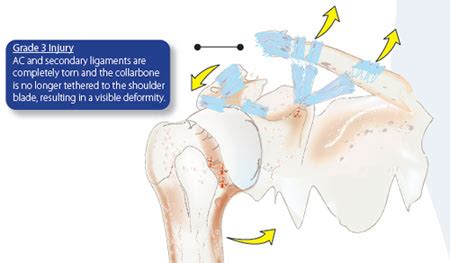 Shoulder Separation