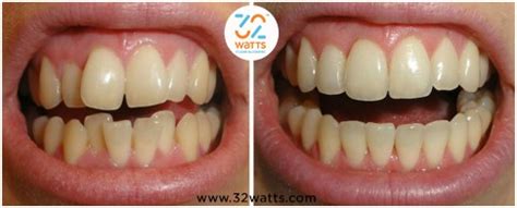 Clear Aligners Before And After In India