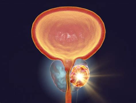 Trial to Test Focal Laser Ablation Therapy for Localized Prostate ...