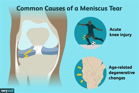 Meniscus Tears: Symptoms, Causes, Diagnosis, Treatment