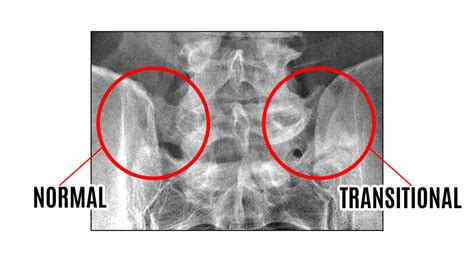 Transitional Vertebrae?