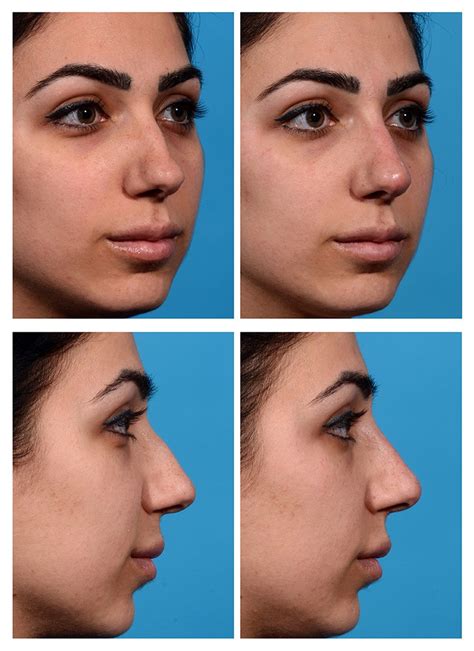 Fillers For Nose Before And After - Injectable Nose Job Rhinoplasty ...