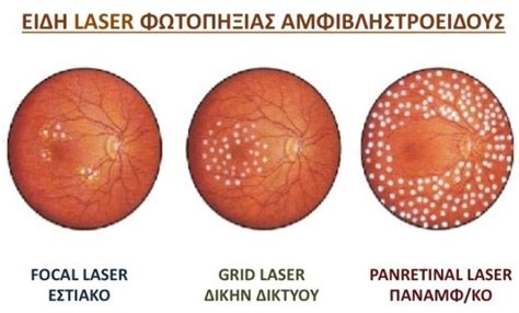 Laser photocoagulation | EYE DAY CLINIC