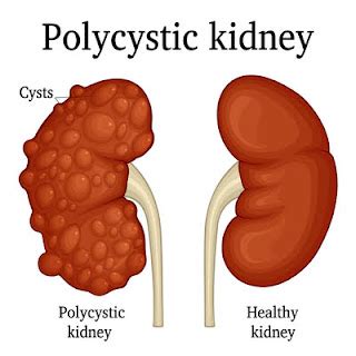 Is Choosing Polycystic Kidney Disease Treatment in Ayurveda Profitable?