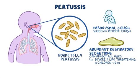 Pertussis: Nursing - Osmosis Video Library