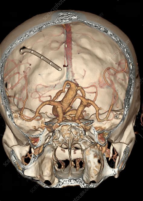 Cerebral Aneurysm Ct