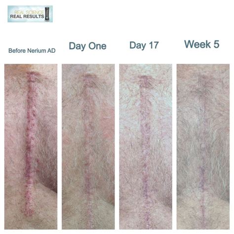 Open heart surgery scar vanishes with continued use of NeriumAD. Works ...