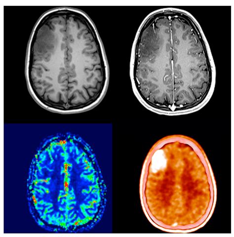 Cat Scan Brain Tumor