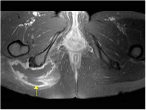 Ischial Tuberosity Bursitis