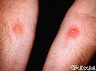 Skin testing - PPD (R arm) and Candida (L): MedlinePlus Medical ...