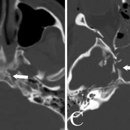 Bone window of CT scan showing transverse clival fracture subtypes ...