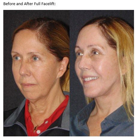 MINI FACELIFT VERSUS FULL FACELIFT San Diego - Golden Triangle Plastic ...