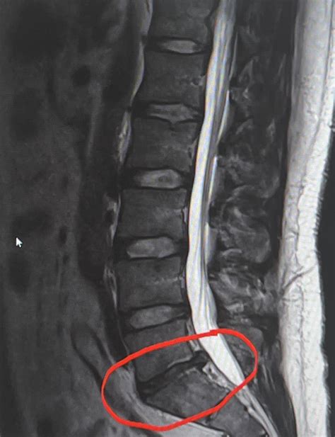 L5-S1 Disc herniation. NEED SURGERY ADVICE! (Story in comments) : r ...