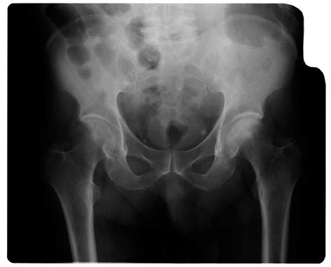 Osteoarthritis X Rays