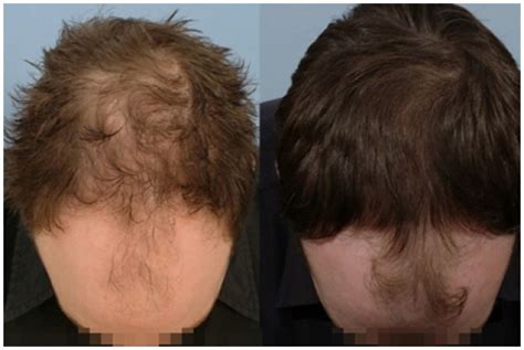 Gallery - Before & After Photos of Hair Loss Treatment - HRBR, UK