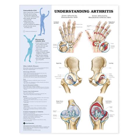 Understanding Arthritis | NIMCO, Inc.