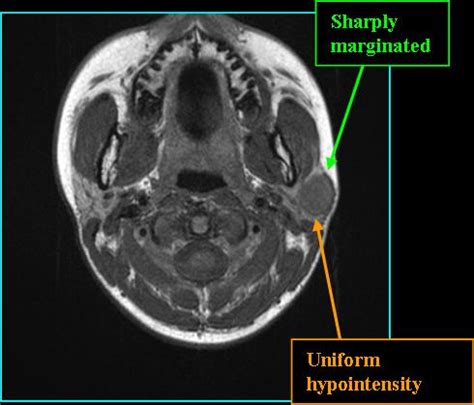 Pleomorphic Adenoma Rads | Iowa Head and Neck Protocols