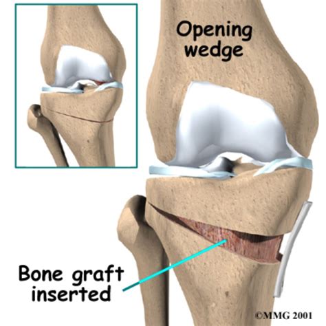 Osteotomy of the Knee