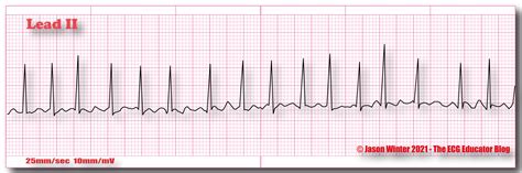 ECG Educator Blog : Atrial Fibrillation (AF)