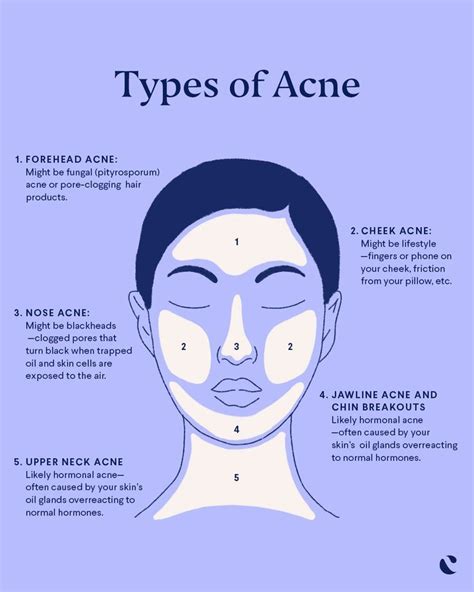 Pimple Face Map | Acne Causes and Prevention