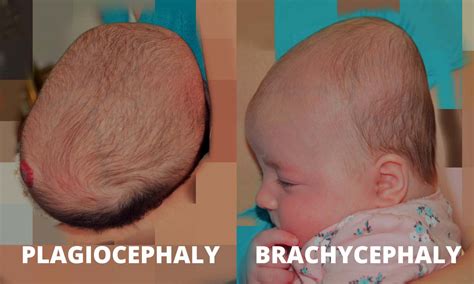 Pediatric Therapy for Plagiocephaly - Lake Forest IL - The Baby ...