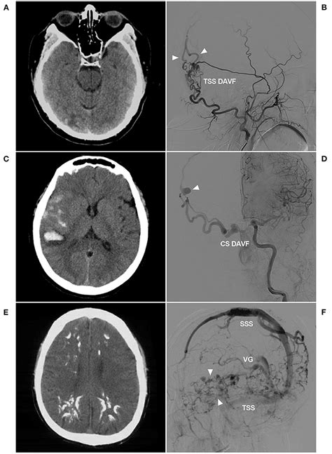 Frontiers | Is the Middle Meningeal Artery the Optimal Path for Dural ...