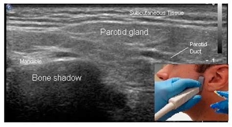 Toxins | Free Full-Text | Ultrasound Guidance for Botulinum Neurotoxin ...