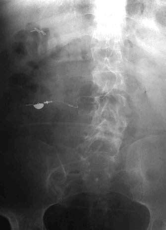 -Plain x-ray showing the lumboperitoneal shunt. | Download Scientific ...