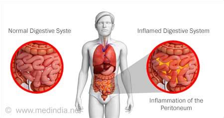 Perforated Viscus: What Is It, Causes, Symptoms, And More, 44% OFF