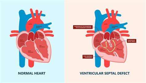 Ventricular Septal defect - Symptoms, Causes & Risk Factors | Dr Raghu