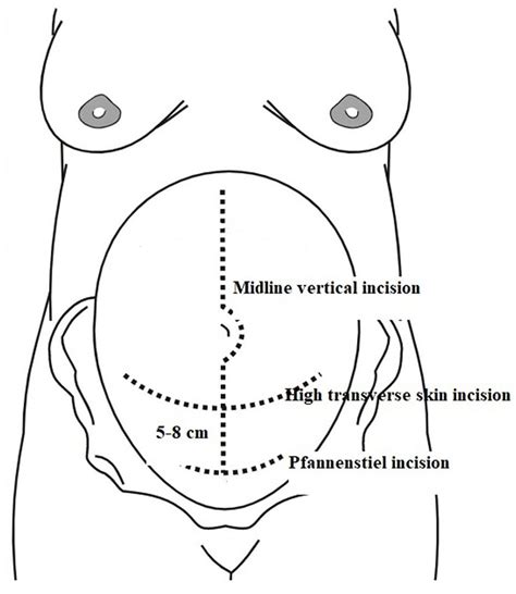 Can high transverse skin incision (Modified Maylard) be a new ...