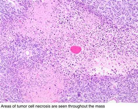 Pathology Outlines - Leiomyosarcoma