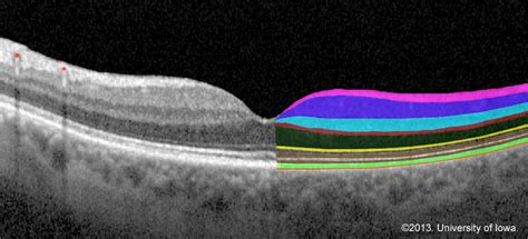 Retinal Detachment: From One Medical Student to Another