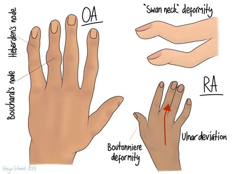 Rheumatic Pain - Gemini Osteopathy