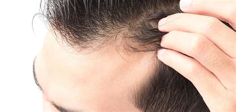 Receding hairline: Causes, Symptoms and Treatment - RepHair