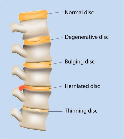 What is a disc? – Diversified Integrated Sports Clinic