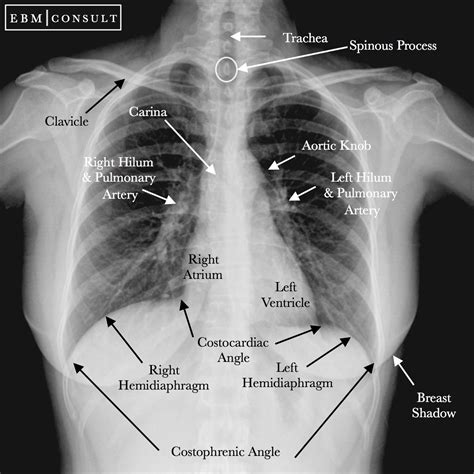 Carina Anatomy - Anatomy Reading Source