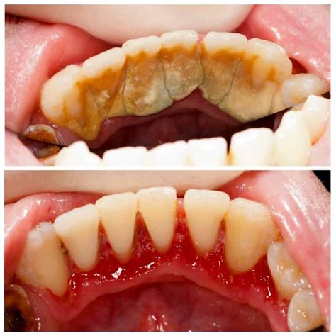 Teeth Cleaning Before and After - Teeth FAQ Blog