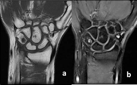 Ganglion Cyst Hand Mri