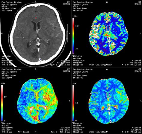 Brain Aneurysm Ct Scan - Diagnosis of a brain aneurysm may require ct ...