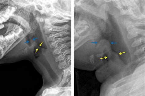 Epiglottitis Cks