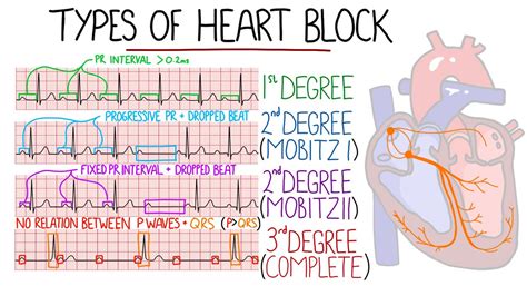 Heart Block Av Second Degree at James Ruppert blog