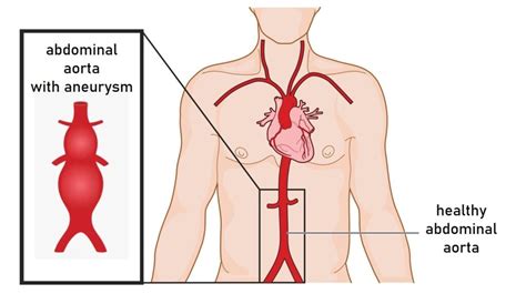 Abdominal Aortic Aneurysm: Causes, Treatment and Prevention