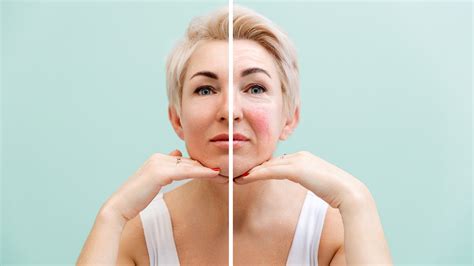 Best Rosacea Treatments: Creams, Gels, and Lasers - GoodRx